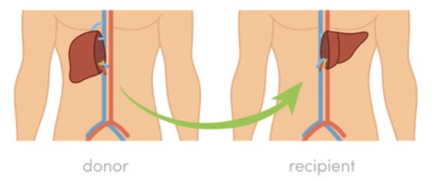 Living Donor Liver Transplant