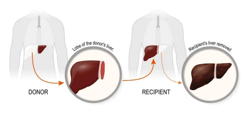 Donor Liver Transplant