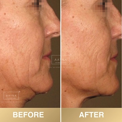 client-before-after-img