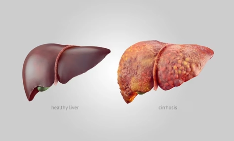 treatment-liver