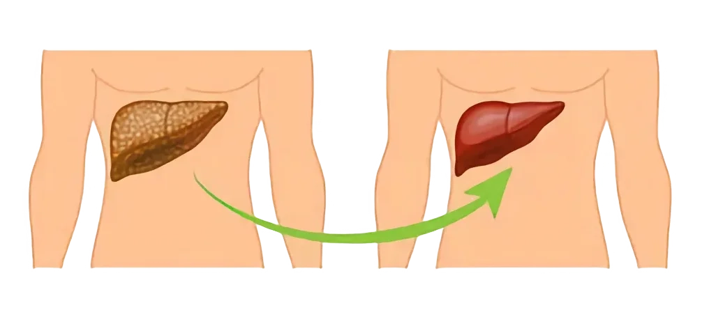 Deceased Donor Liver Transplant